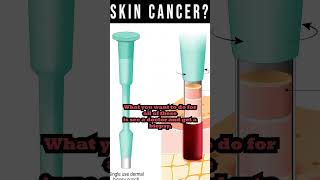 Skin Cancer Dont Ignore The Warning Signs [upl. by Ayotahc]