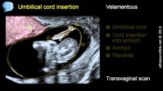 Velamentous insertion of the umbilical cord [upl. by Pucida]