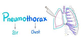 Pneumothorax  Spontaneous vs Tension Pneumothorax  Lung Physiology  Pulmonary Medicine [upl. by Idnem688]