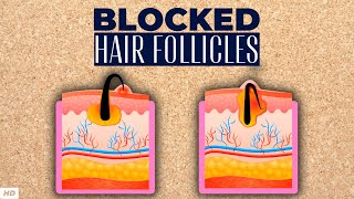 Blocked Hair Follicle – Everything You Need To Know [upl. by Bolt491]