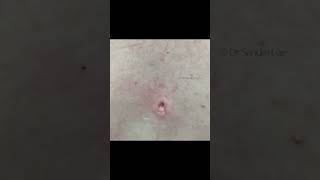 Some Clean Pops from Dr Pimple Popper [upl. by Ayanahs524]