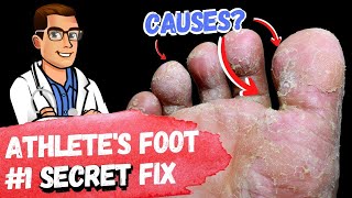 🦶BEST 9 Athletes Foot Fungus Remedies amp the 1 Big Mistake🦶 [upl. by Navinod646]