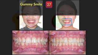 Class I Deep Bite with Gummy Smile｜【Chris Chang Ortho】CC810 [upl. by Bibby352]