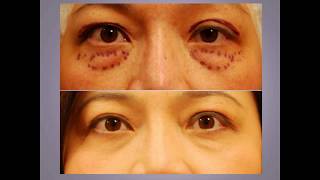 ChaseLayMD Ptosis Droopy Eyelid Surgery [upl. by Aidil]