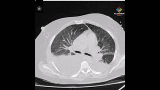 Konjestif Kardiyojenik Pulmoner Ödemde Akciğer Tomografisi BT Bulguları [upl. by Enomis225]