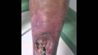 Venous leg ulcer [upl. by Udale]