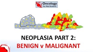 2 Neoplasia part 2 Differences between benign and malignant neoplasms [upl. by Albert]