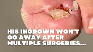 His INGROWN wont GO AWAY after MULTIPLE SURGERIES [upl. by Eldwen]