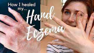 Hand Eczema Treatment Natural Cure  7 Tips How I Healed My Hand ECZEMA  HEAL ECZEMA NATURALLY [upl. by Oicnerual]