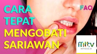 SARIAWAN 4 Ini Dia Obat Sariawan Rekomendasi Dokter Gigi [upl. by Joe]