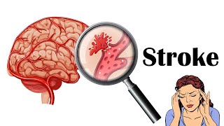 Stroke  Types Causes Risk Factors Signs amp Symptoms [upl. by Phox]