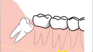 alte Version Erklärung spezieller Probleme und Risiken bei der Weisheitszahnentfernung [upl. by Eikcim]