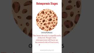 osteoporosis symptoms  shorts  symptoms of osteoporosis  diyas funplay  health awareness video [upl. by Hamimej]