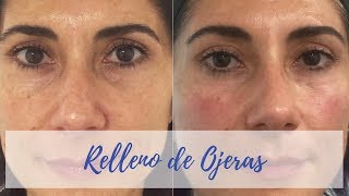 💉RELLENO de OJERAS con ÁCIDO HIALURÓNICO❗️Antes y Después ✅ [upl. by Rosamond]