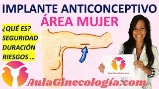 IMPLANTE ANTICONCEPTIVO ¿QUÉ ES SEGURIDAD DURACIÓN RIESGOS  Ginecología y Obstetricia [upl. by Els]