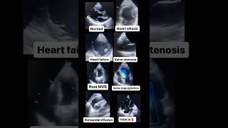 Echocardiogram NORMAL vs ABNORMAL radiology cardiology [upl. by Kermit]