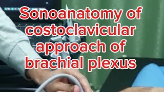 Sonoanatomy of costoclavicular approach of the brachial plexus [upl. by Lael]