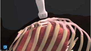 3D Comment échographie pulmonaire  échographe SonoSite [upl. by Illona856]