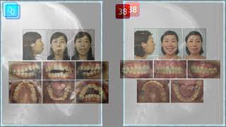 Miniscrew placement site and its impact on the treatment of Class ll malocclusion combined with ante [upl. by Bliss722]