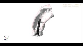 Medtronic CoreValve simulation [upl. by Yme811]