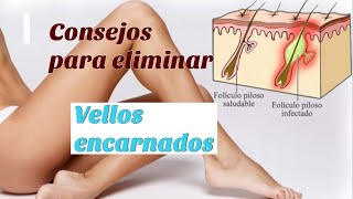 Consejos Para Deshacerte De Los Vellos Encarnados  EcoDaisy [upl. by Ardnosak908]