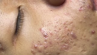 ACNE TREATMENT VU QUYNH MI Acne On Boys Nose 2024 [upl. by Harriman141]