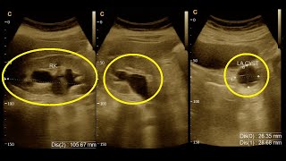 Grade  3  Hydroureteronephrosis  Ultrasound  Report  Amader hospital  Ultrasonography report [upl. by Htinnek]