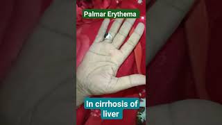 Palmar erythema in cirrhosis of liver [upl. by Acacia]