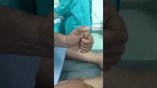 Trigger thumb clinical presentation حالة اختناق الوتر القابض لاصبع الابهام [upl. by Weston]