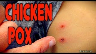 CHICKENPOX Live Diagnosis  Dr Paul [upl. by Nylesoy604]