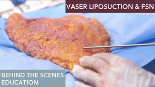 How does Vaser Liposuction work [upl. by Ailecara]