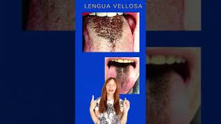 Lengua vellosa shorts [upl. by Noira57]