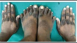 Dark Knuckles Causes and Treatment in Hindi  हाथों के कालेपन का ईलाज  Acanthosis nigricans Toes [upl. by Aidyl459]