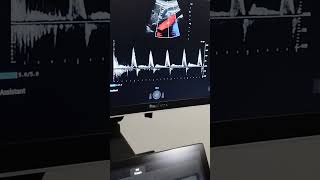 PRACTICA ECO DOPPLER ABDOMINAL [upl. by Sherill]