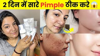 My Oily Acne Prone Skincare Routine 2024  Get Rid Of Pimples In Just 2 Days 😱 [upl. by Prissy]