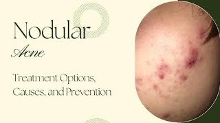 Nodular Acne  Pimples treatment  Chemical Peels  IPL Laser [upl. by Ellerrehc]