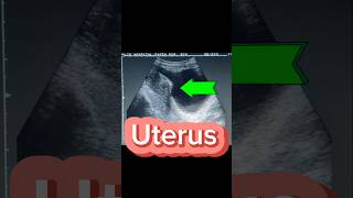 Mass in Uterus  Mixed Echogenic lesion  Fibroid on Ultrasound [upl. by Aniala479]