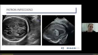 VENTRICULOMEGALIA CEREBRAL FETAL [upl. by Leterg855]