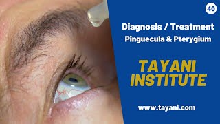 Pinguecula amp Pterygium Diagnosis  Tayani Institute [upl. by Mcneely442]