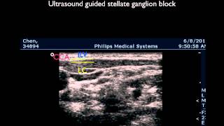 Ultrasound guided stellate ganglion block [upl. by Gagne]