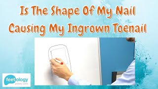 Is The Shape Of My Nail Causing My Ingrown Toenail [upl. by Yehudi]