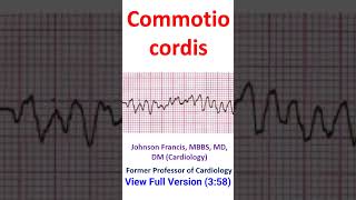 Commotio cordis [upl. by Hertz832]