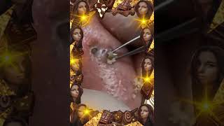 Blackheads Removal  Acne Treatment and Very Satisfying Satisfying Pimple pop blackheads [upl. by Ahsito796]