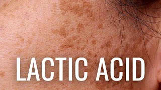 WHY Lactic Acid is Best For Hyperpigmentation [upl. by Shiroma]