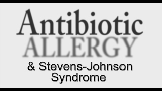 3 Errors Causing AntiBiotic Allergy amp StevensJohnson Syndrome [upl. by Ecirrehs]