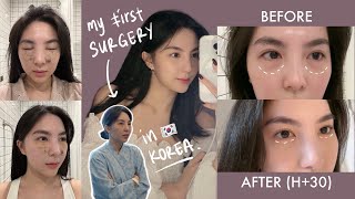 My FIRST SURGERY in Korea 🇰🇷  PRICE  Undereye Fat Removal  VLOG [upl. by Einama297]