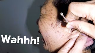 Removing Something STUCK amp TRAPPED in Mans Ear [upl. by Cormick]