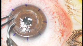 Trapianto cheratoplastica lamellare con microcheratomo  Corneal transplantation with microkeratome [upl. by Asennav]