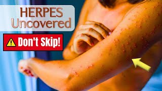 Herpes Uncovered Treatments Research and Hope for a Cure herpes herpesawareness [upl. by Asilef]