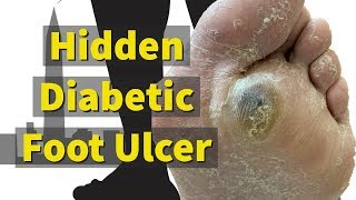 Hidden Diabetic Foot Ulcer [upl. by Haduhey587]